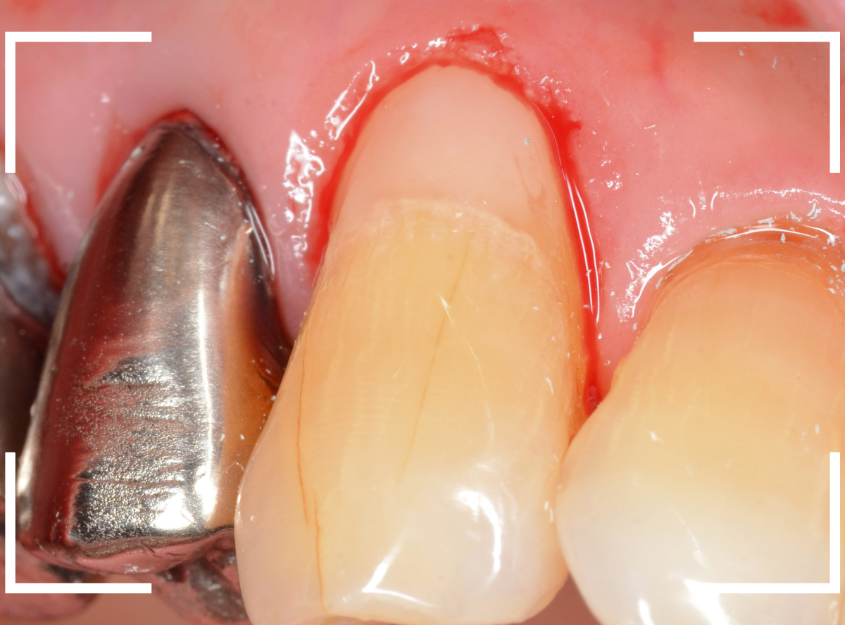 コンポジットレジン治療8-3