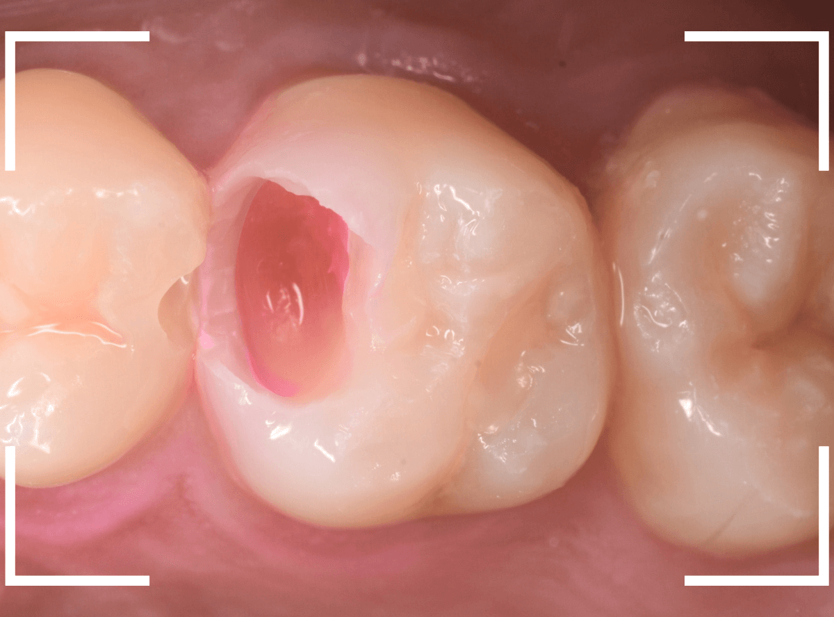 気づかないうちに深い虫歯4-4