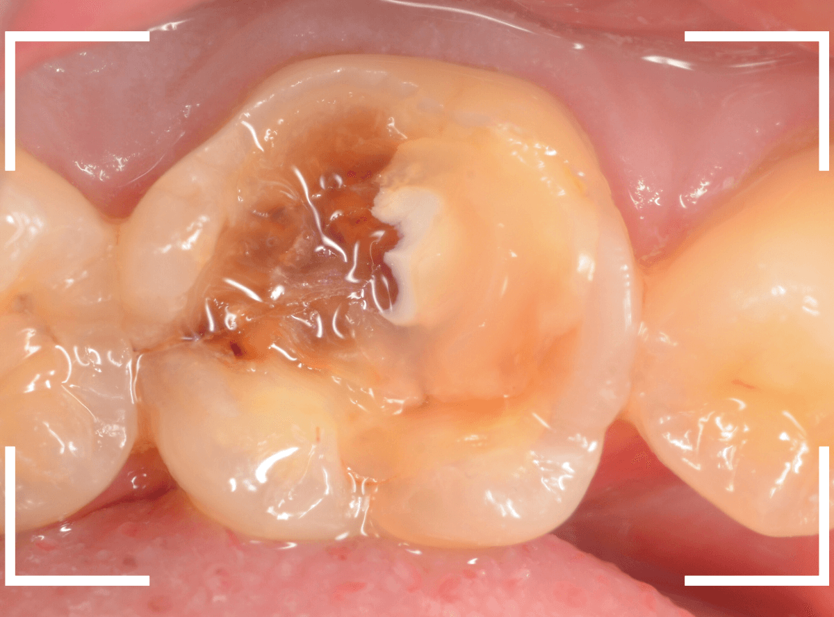 レントゲンでわかりづらい虫歯21-4