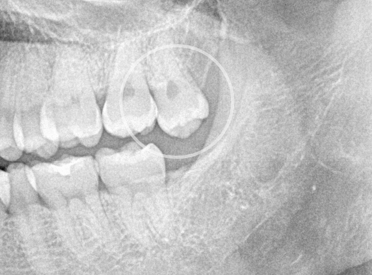 おやしらずの抜歯2-1