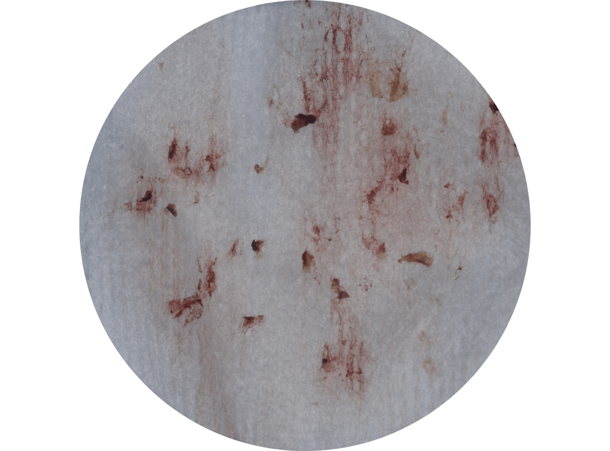 歯肉の中の歯石（歯肉縁下歯石）除去(画像)1-3