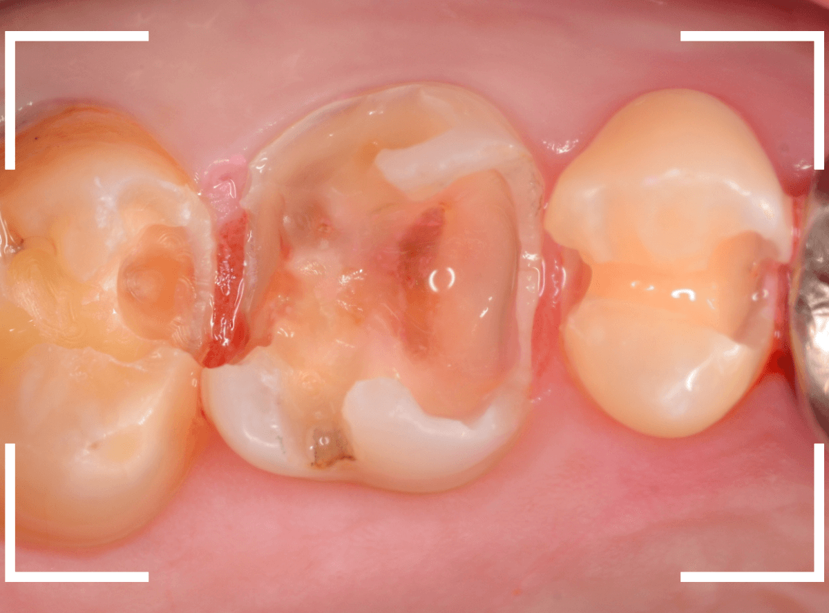 つめものの下の深い虫歯(画像)10-1