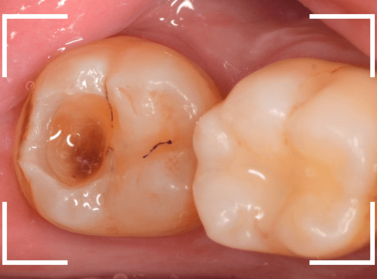つめものの下の深い深い虫歯19-5