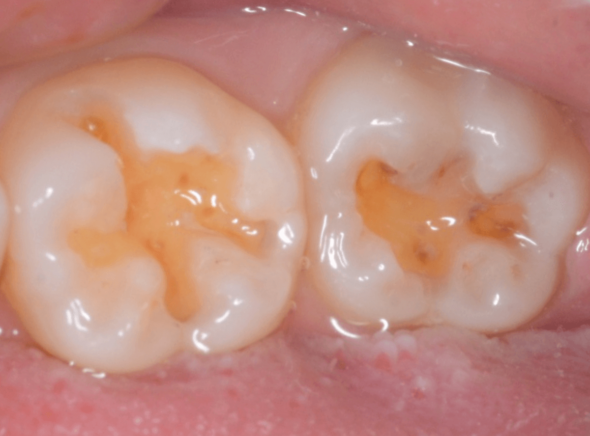 コンポジットレジン治療3-5