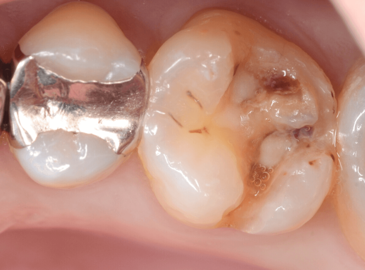 コンポジットレジン治療7-1