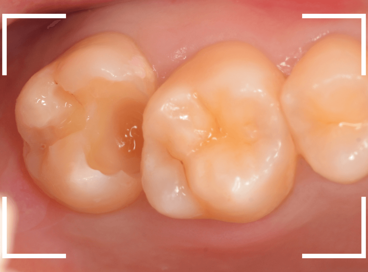 歯と歯の間の虫歯20-4