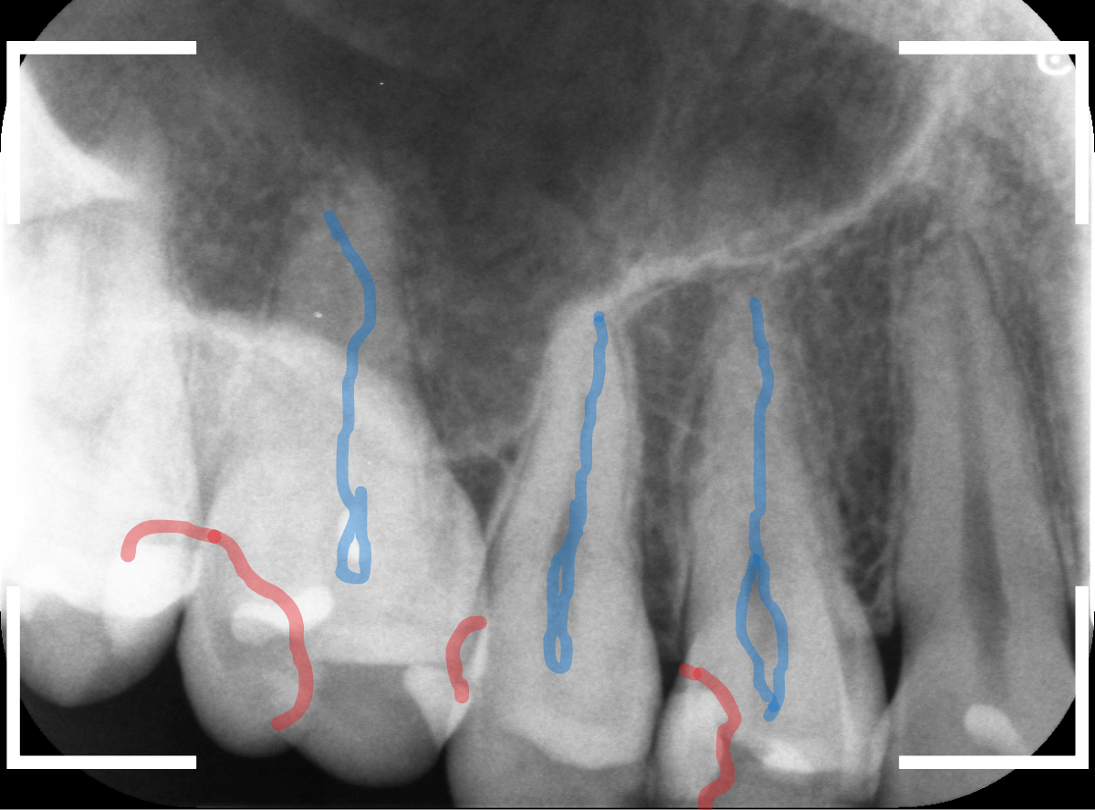 歯と歯の間の虫歯17-2