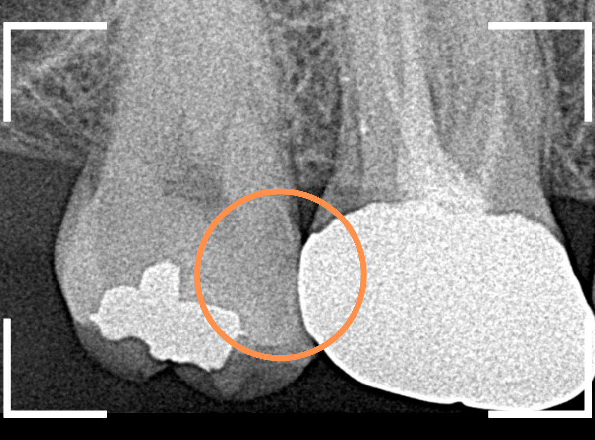 歯と歯の間の虫歯14-2