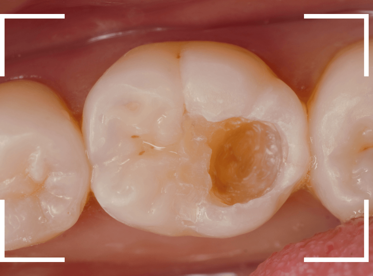 レントゲンでわかりづらい虫歯18-3