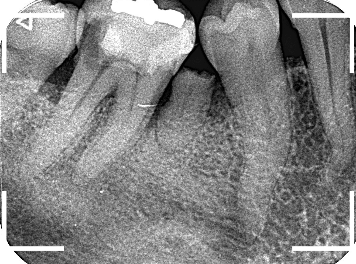 つめものの下の深い深い虫歯12-1