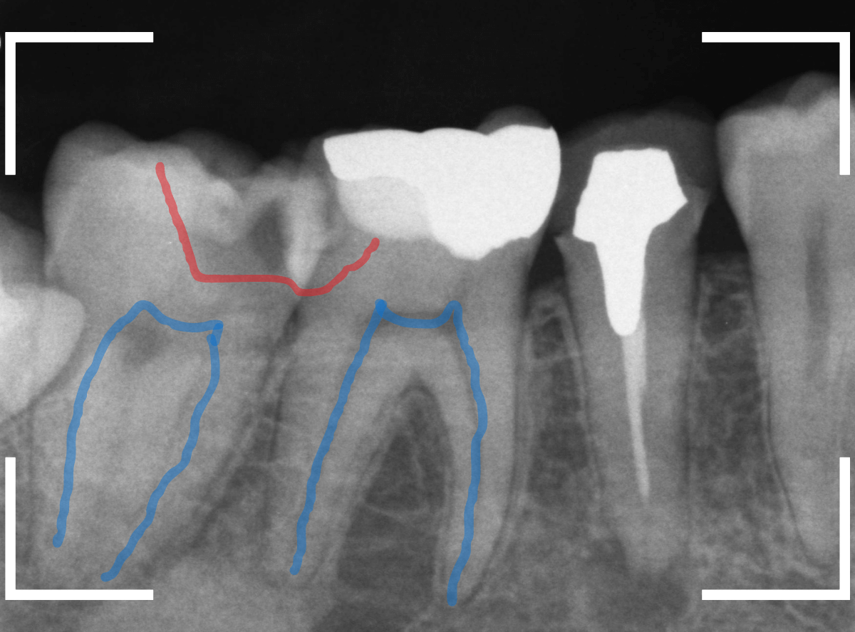 歯と歯の間の虫歯18-2