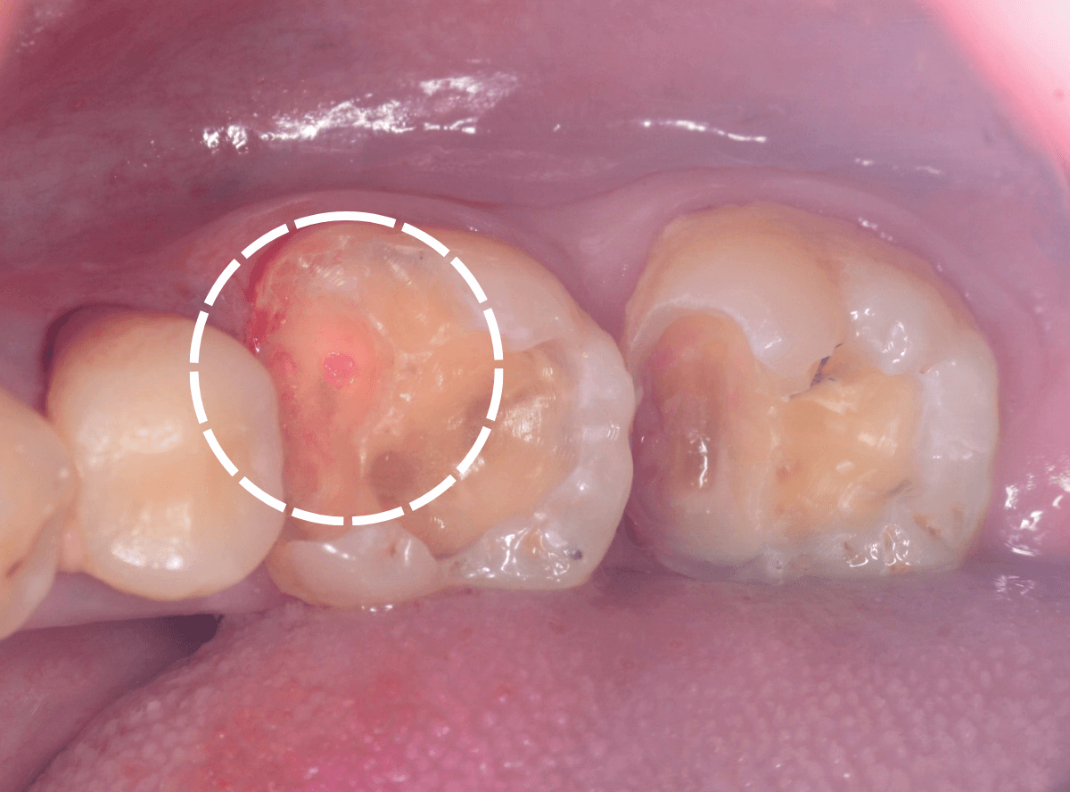 つめものの下の深い虫歯(画像)1-5