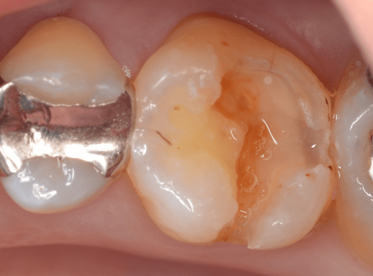 コンポジットレジン治療7-2