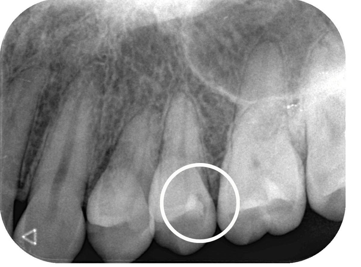 つめものの下の深い深い虫歯11-1