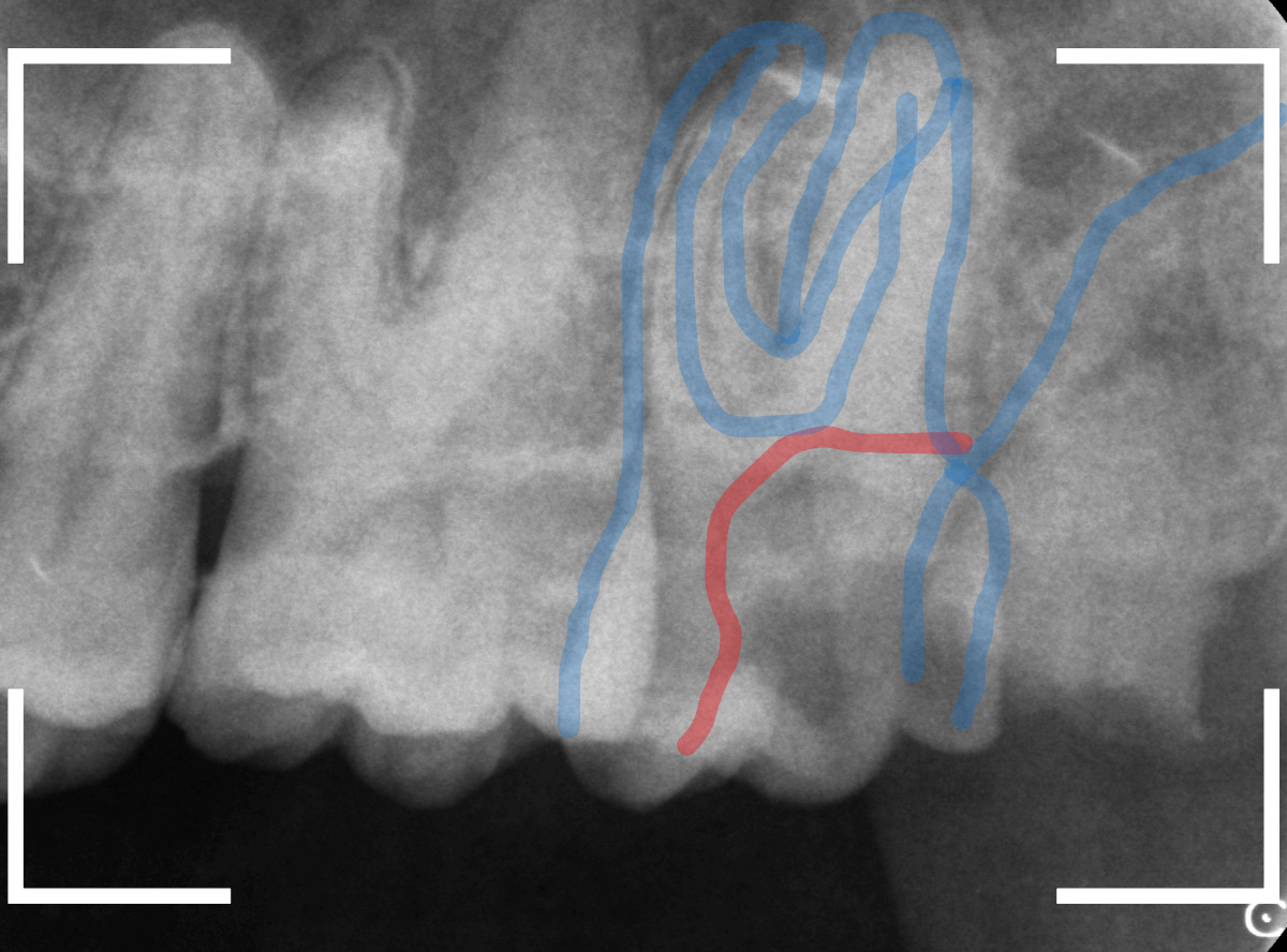 虫歯を放置して、抜歯7-3