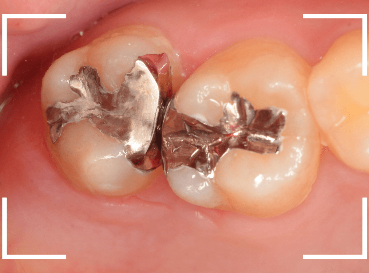 歯と歯の間の虫歯20-7