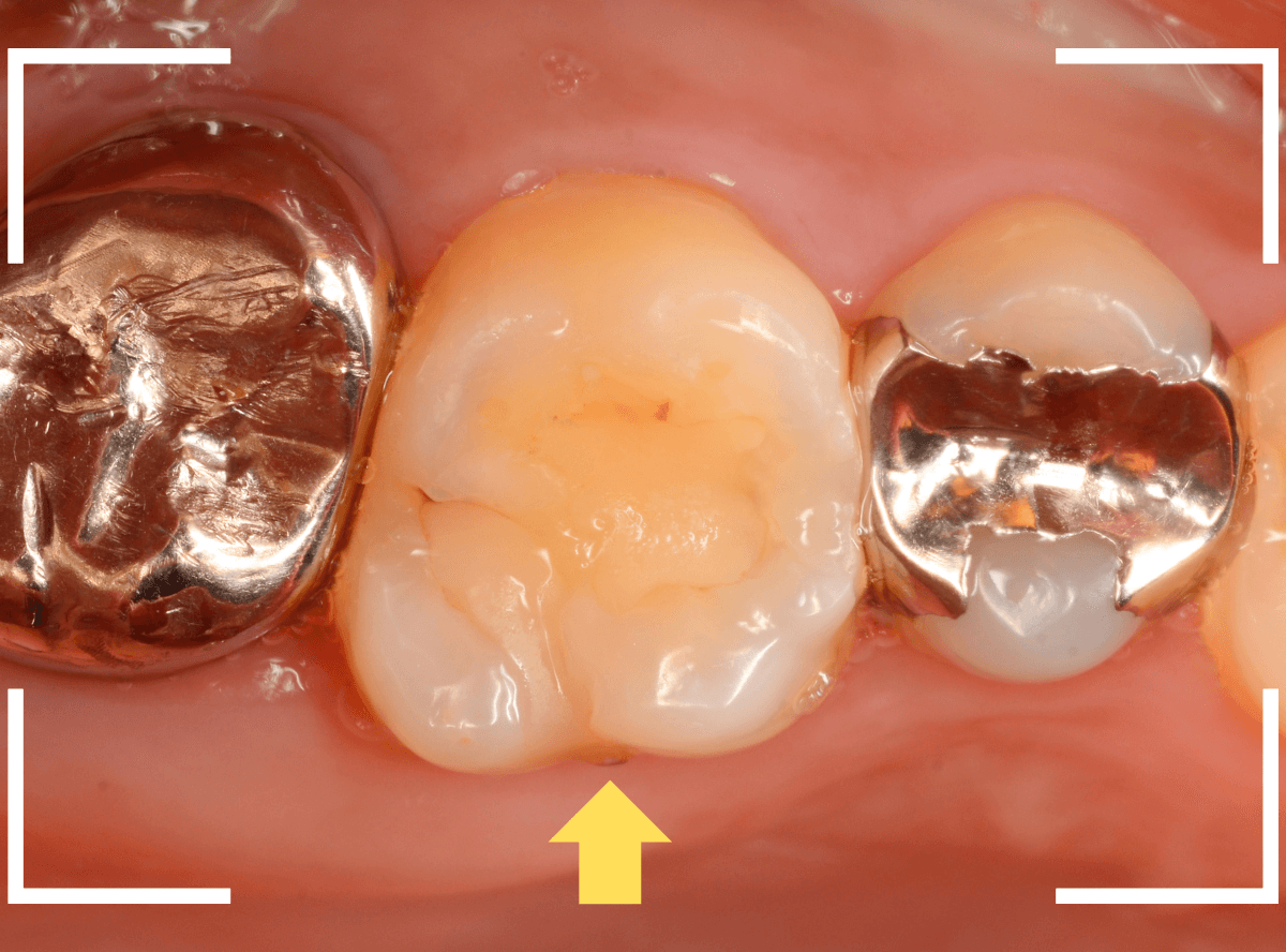 レントゲンでわかりづらい虫歯15-1