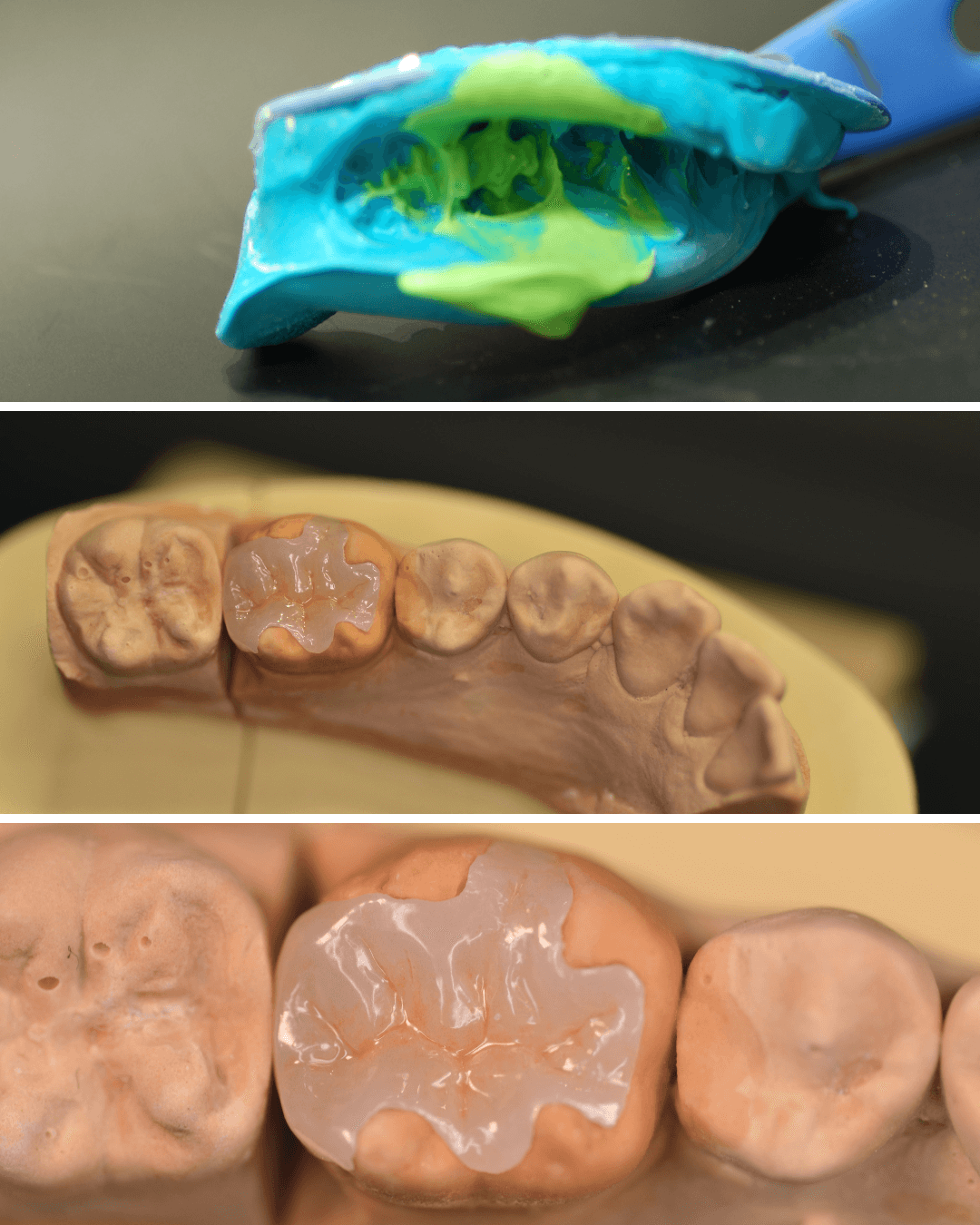 セラミック治療(インレー)7-5