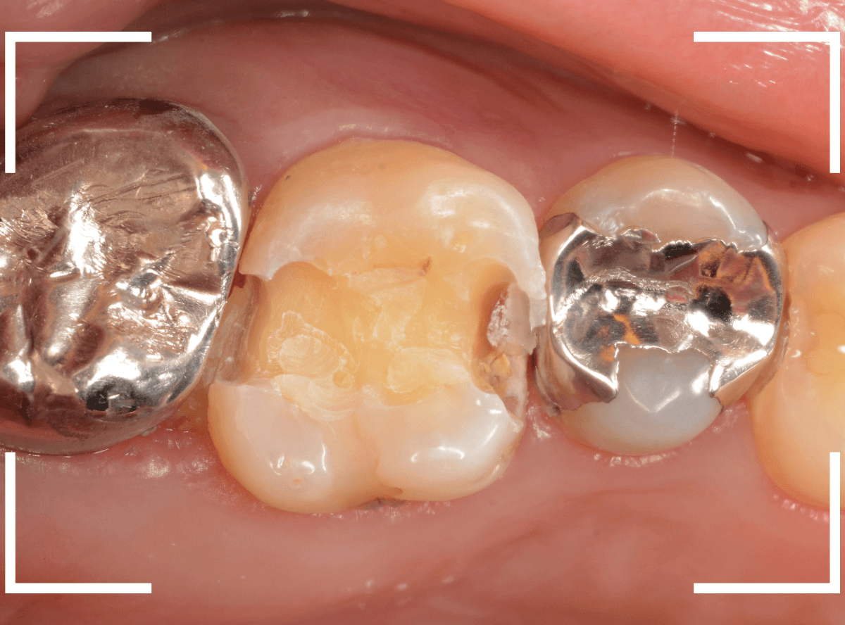 レントゲンでわかりづらい虫歯15-3