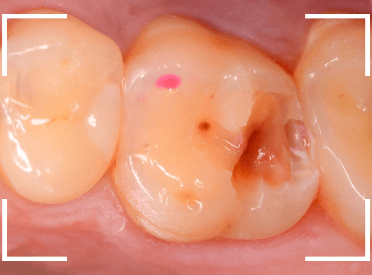 セラミック治療(インレー)24-4