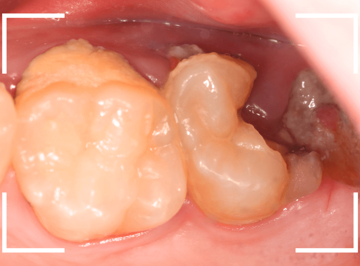 虫歯を放置して、抜歯7-1