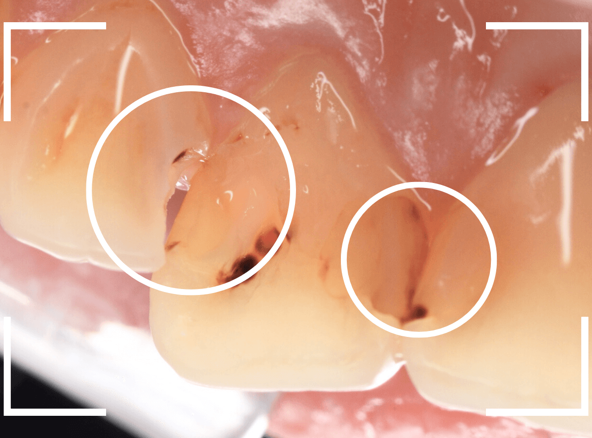 コンポジットレジン治療6-2