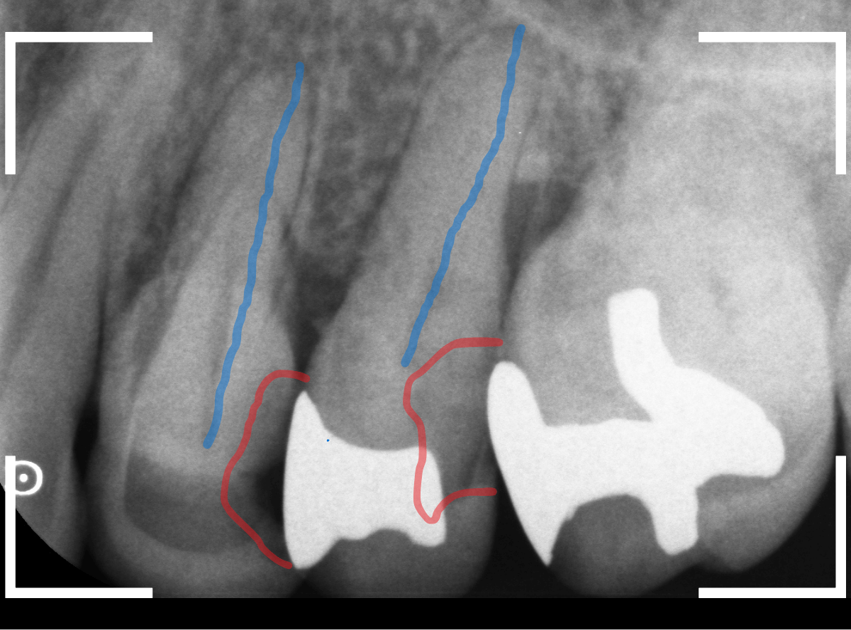 歯と歯の間の虫歯21-1