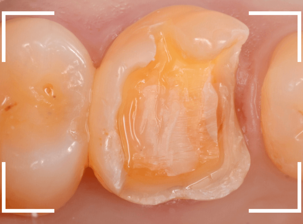 セラミック治療(インレー)19-4