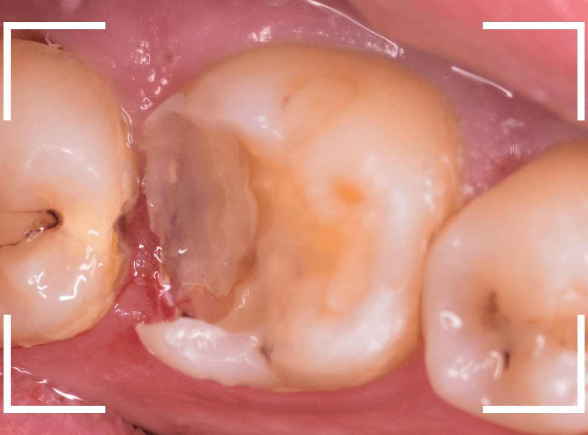 歯と歯の間の虫歯23-3
