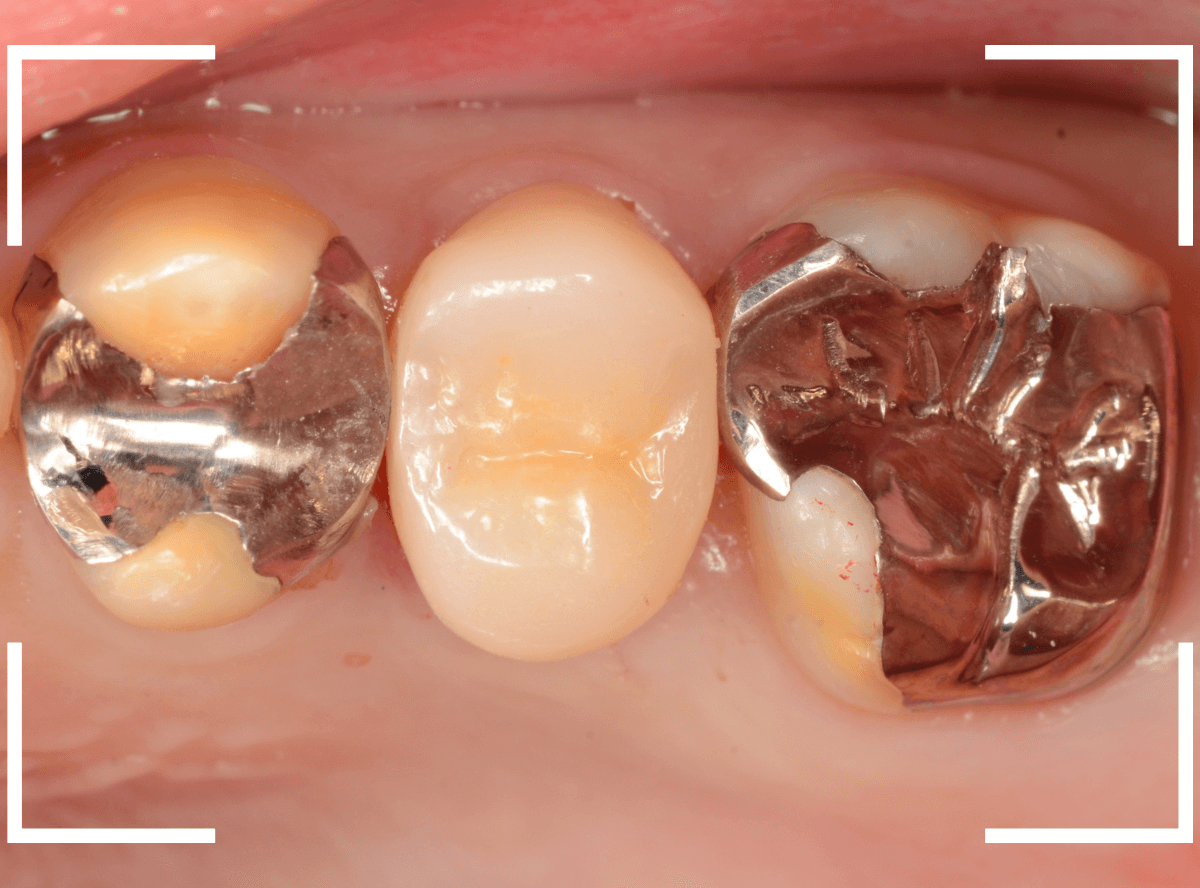 セラミック治療(クラウン・奥歯)13-4
