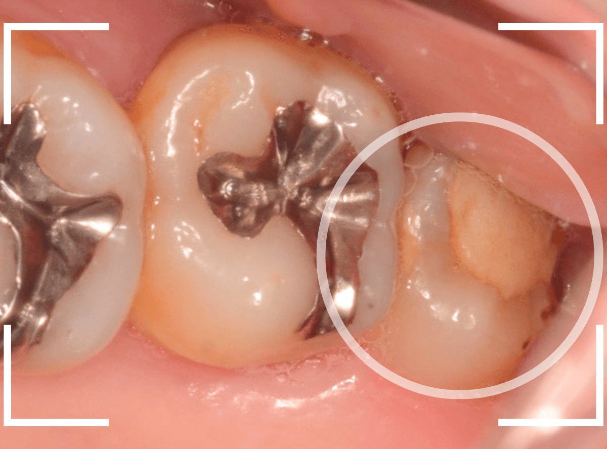 気づかないうちに深い虫歯18-1