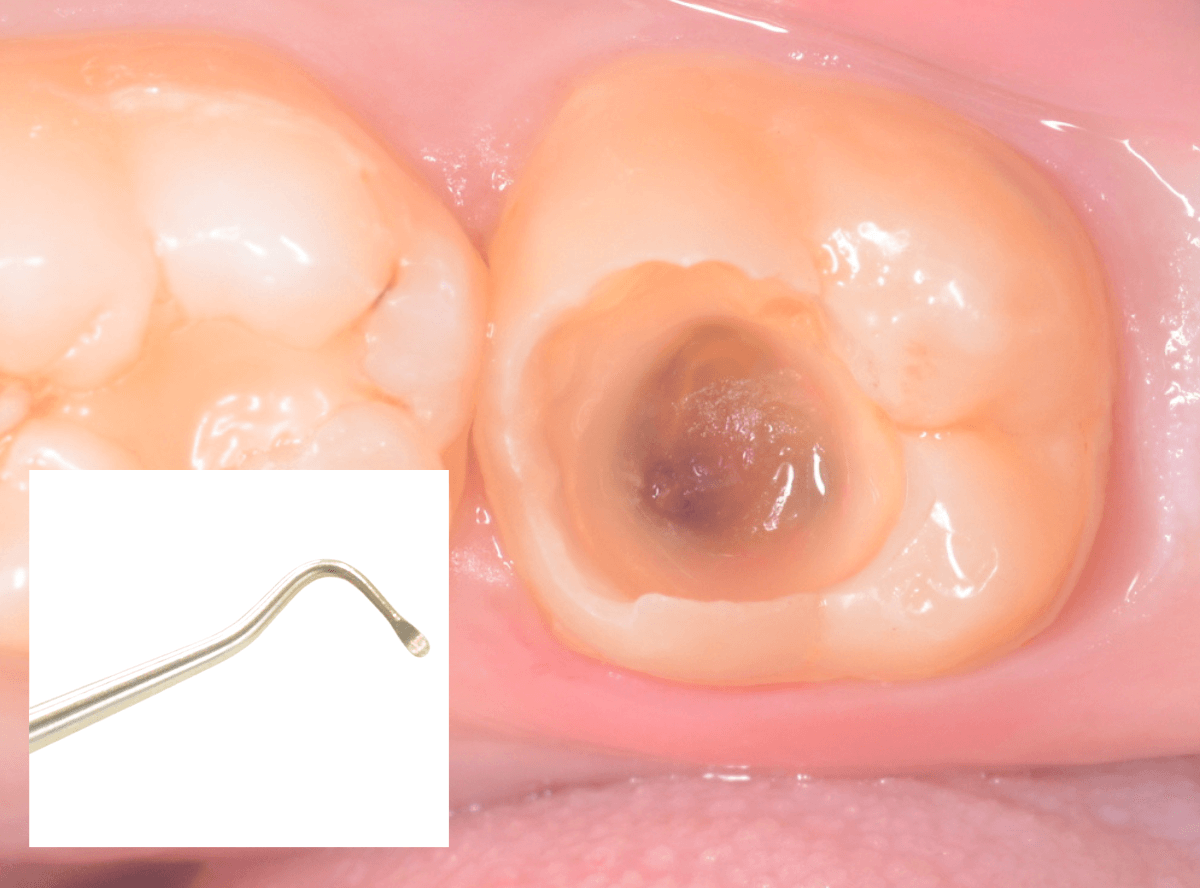 つめものの下の深い虫歯(画像)2-6