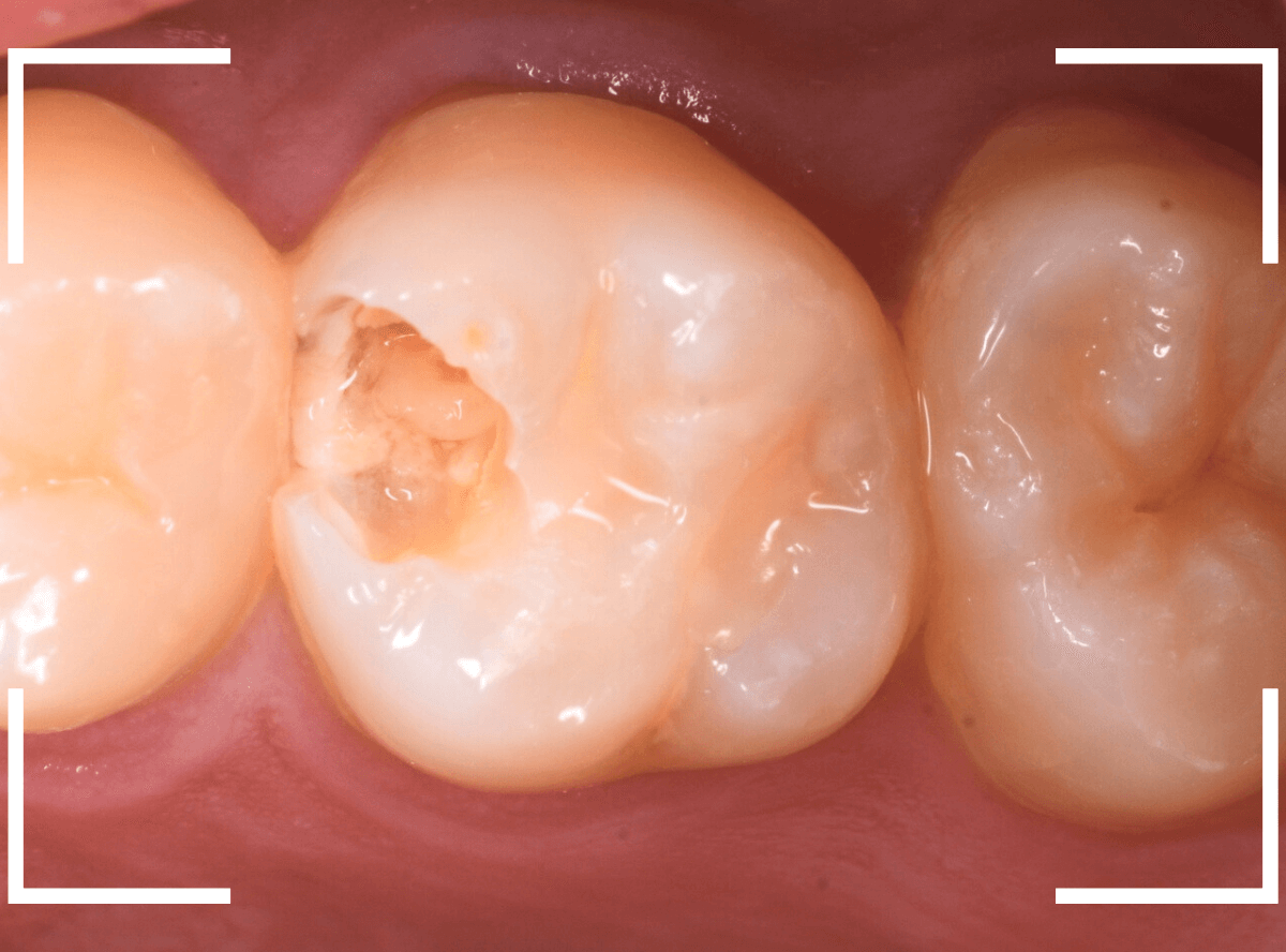 気づかないうちに深い虫歯4-3