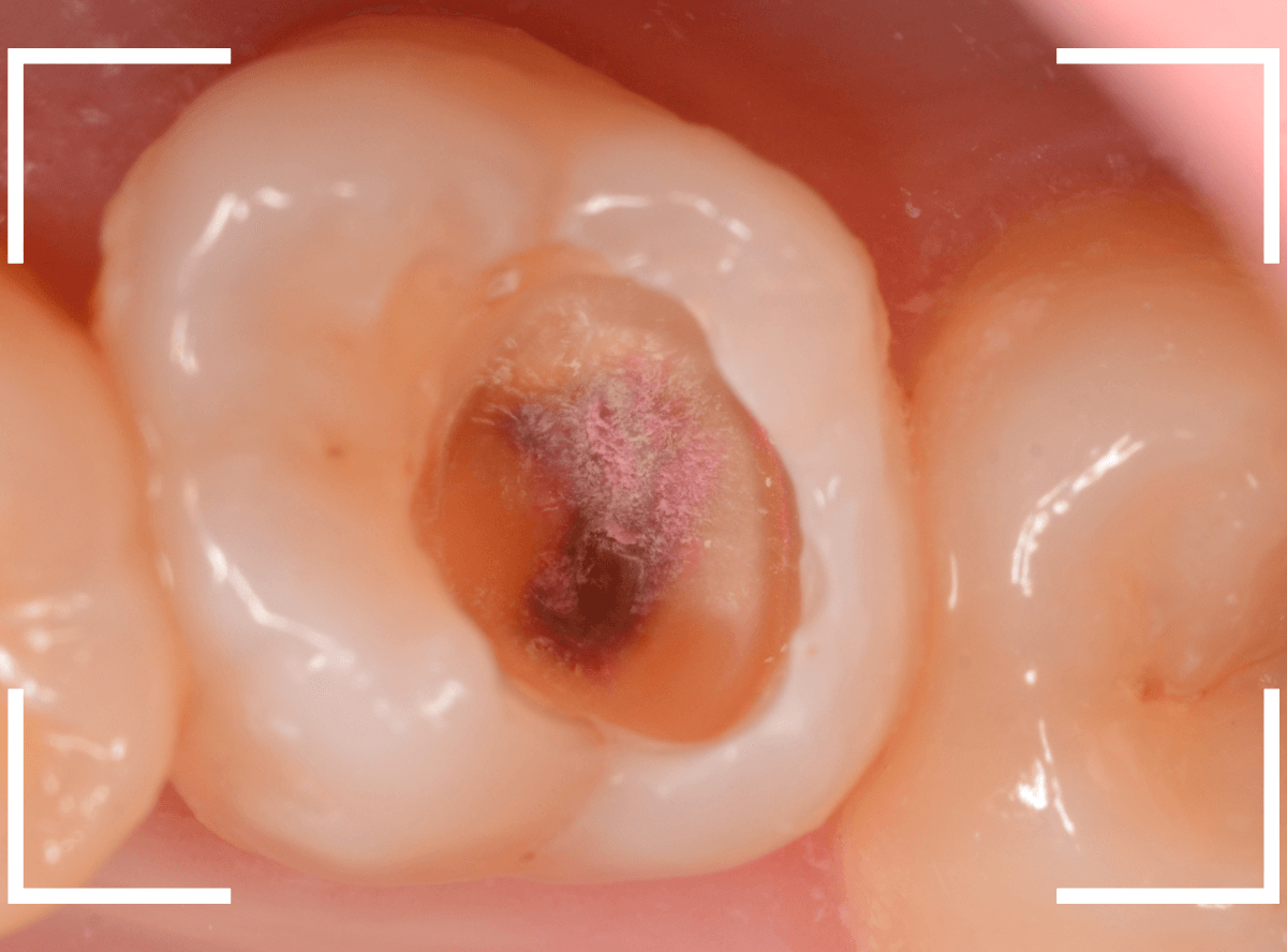 つめものの下の深い深い虫歯20-1