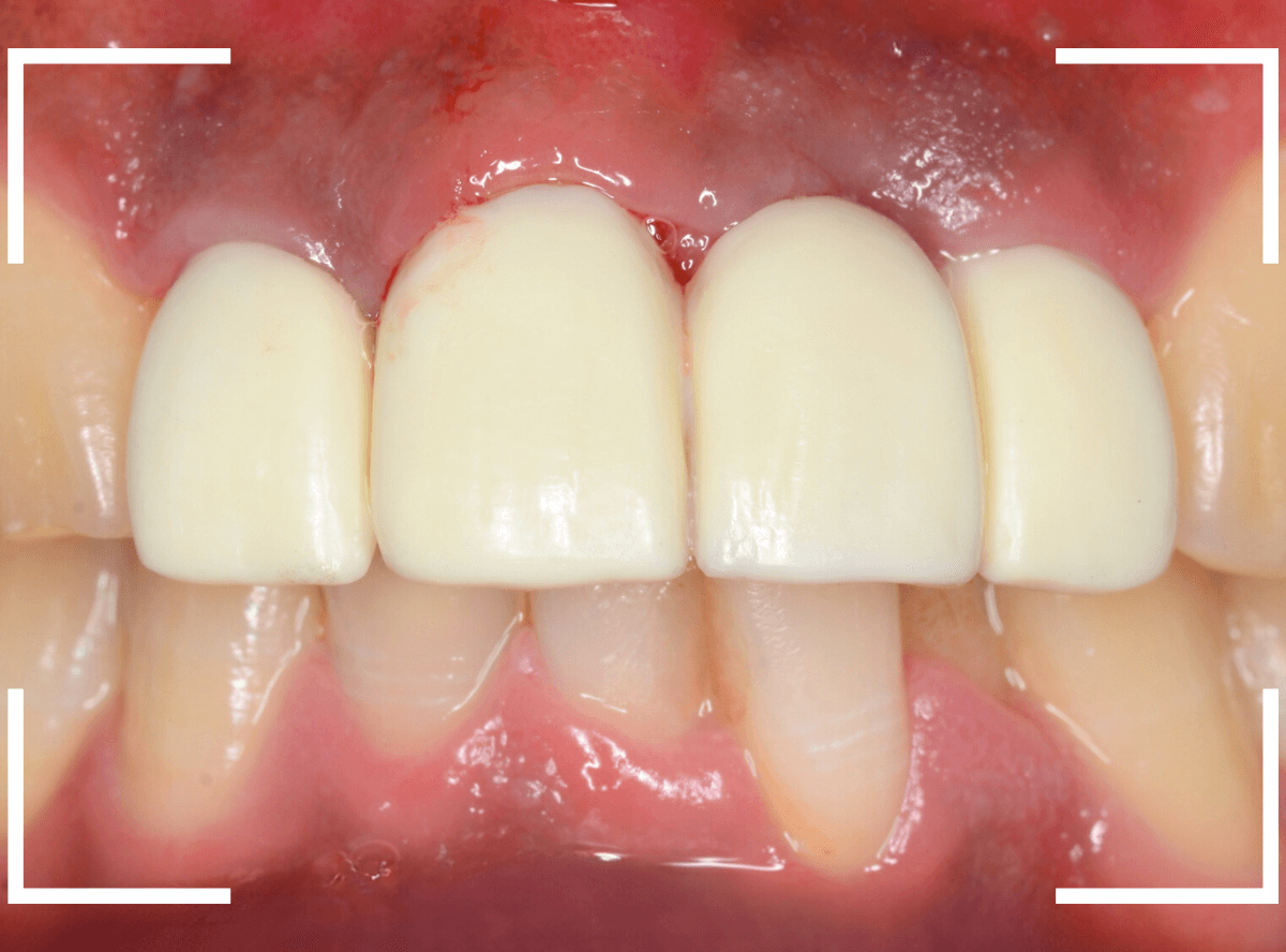 セラミック治療(前歯・クラウン)4-4