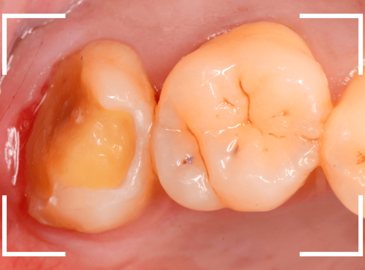 セラミック治療(インレー)31-2