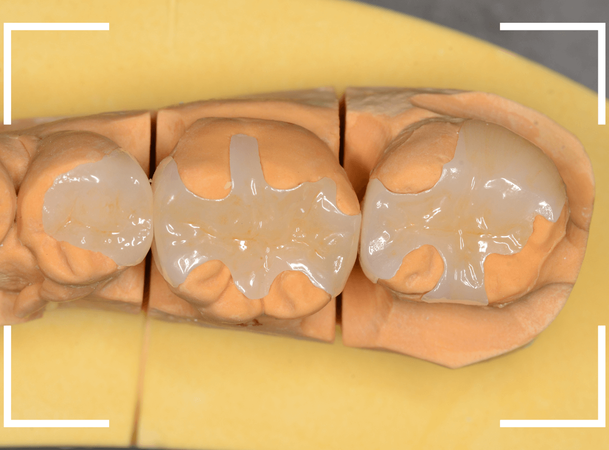 セラミック治療(インレー)30-5