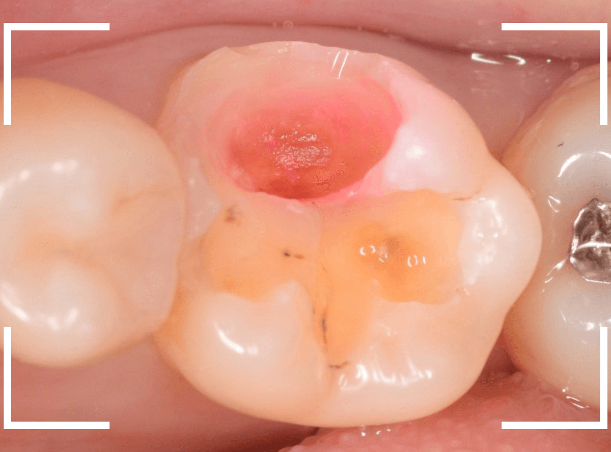 つめものの下の深い虫歯(画像)10-1