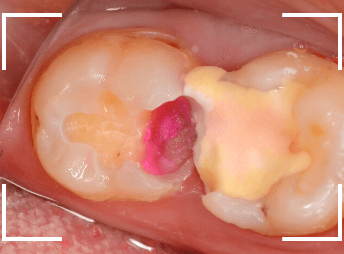 歯と歯の間の虫歯23-8
