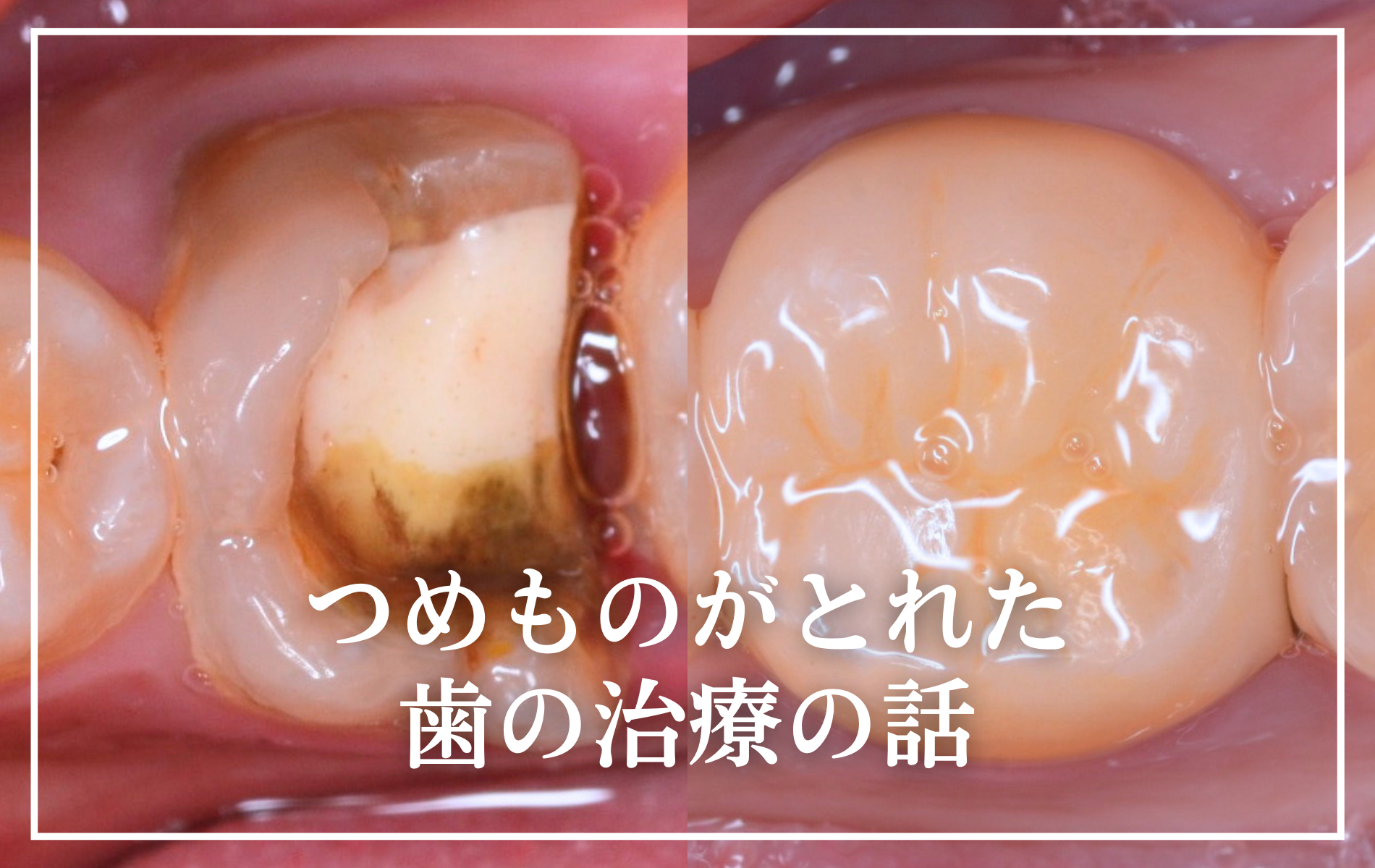 つめものが取れた歯の治療の話-タイトル