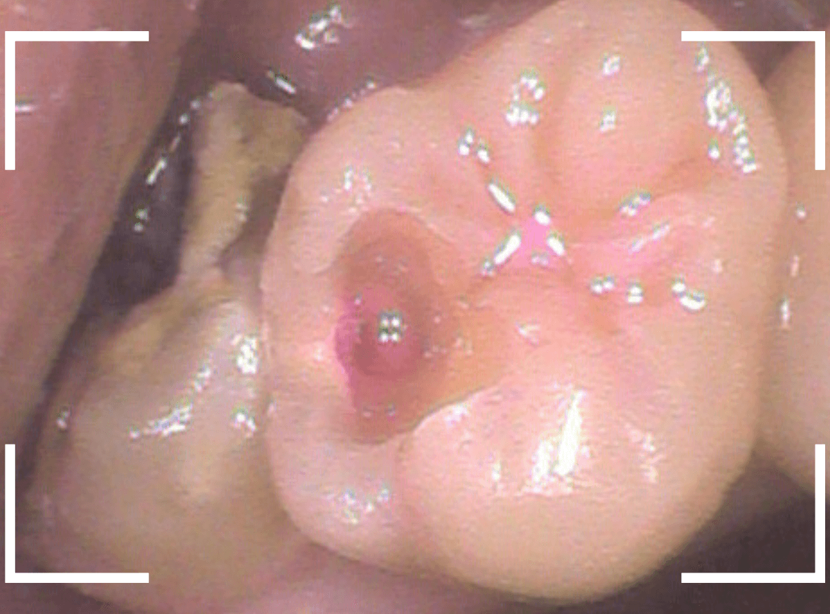 おやしらずの抜歯11-3