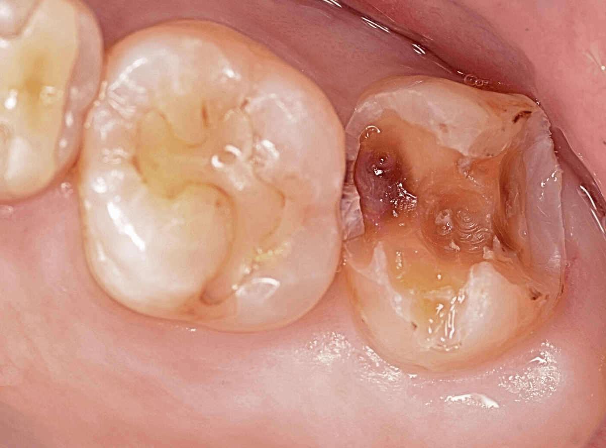 つめものの下の深い虫歯(画像)7-4