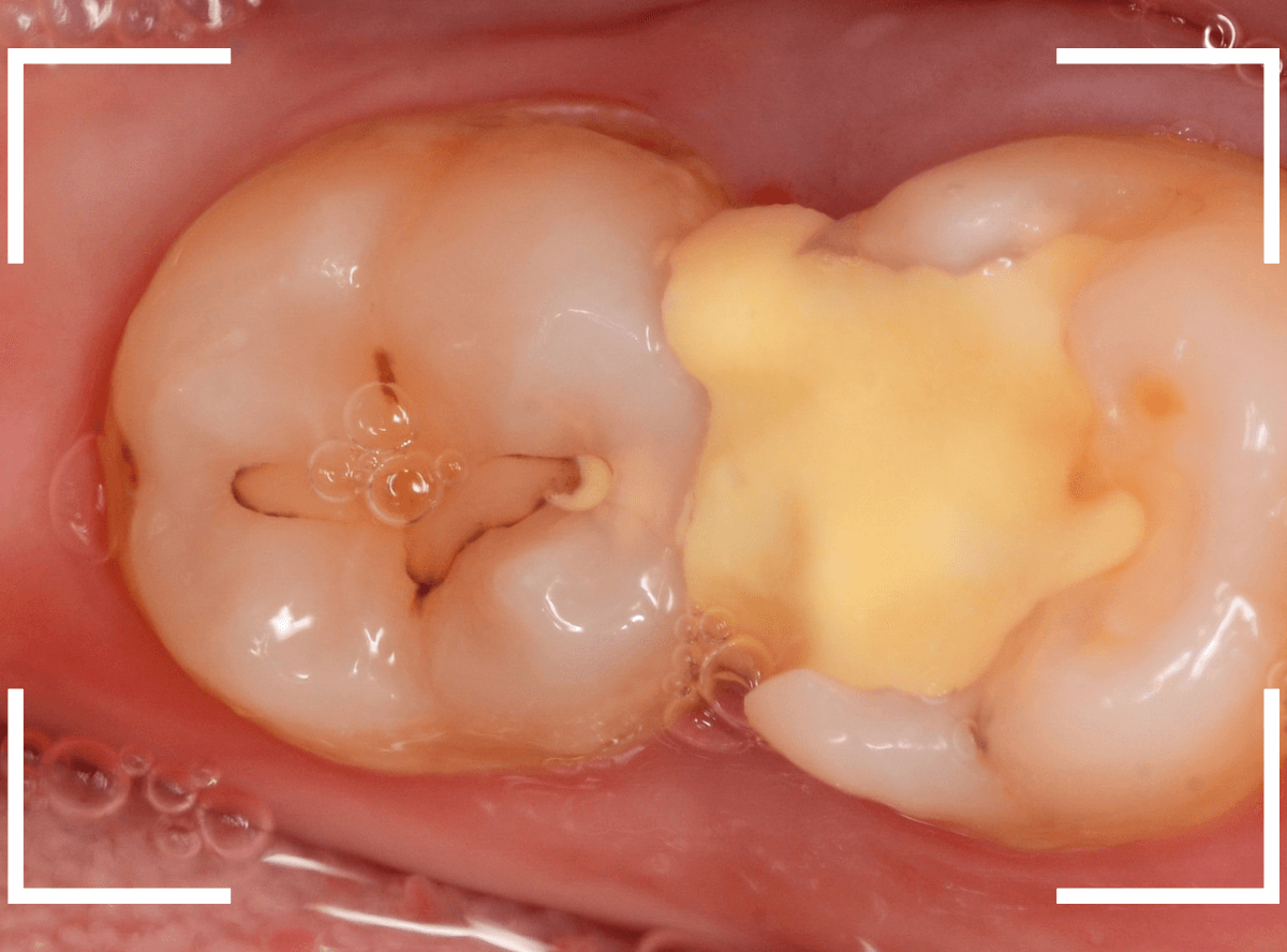 歯と歯の間の虫歯23-6