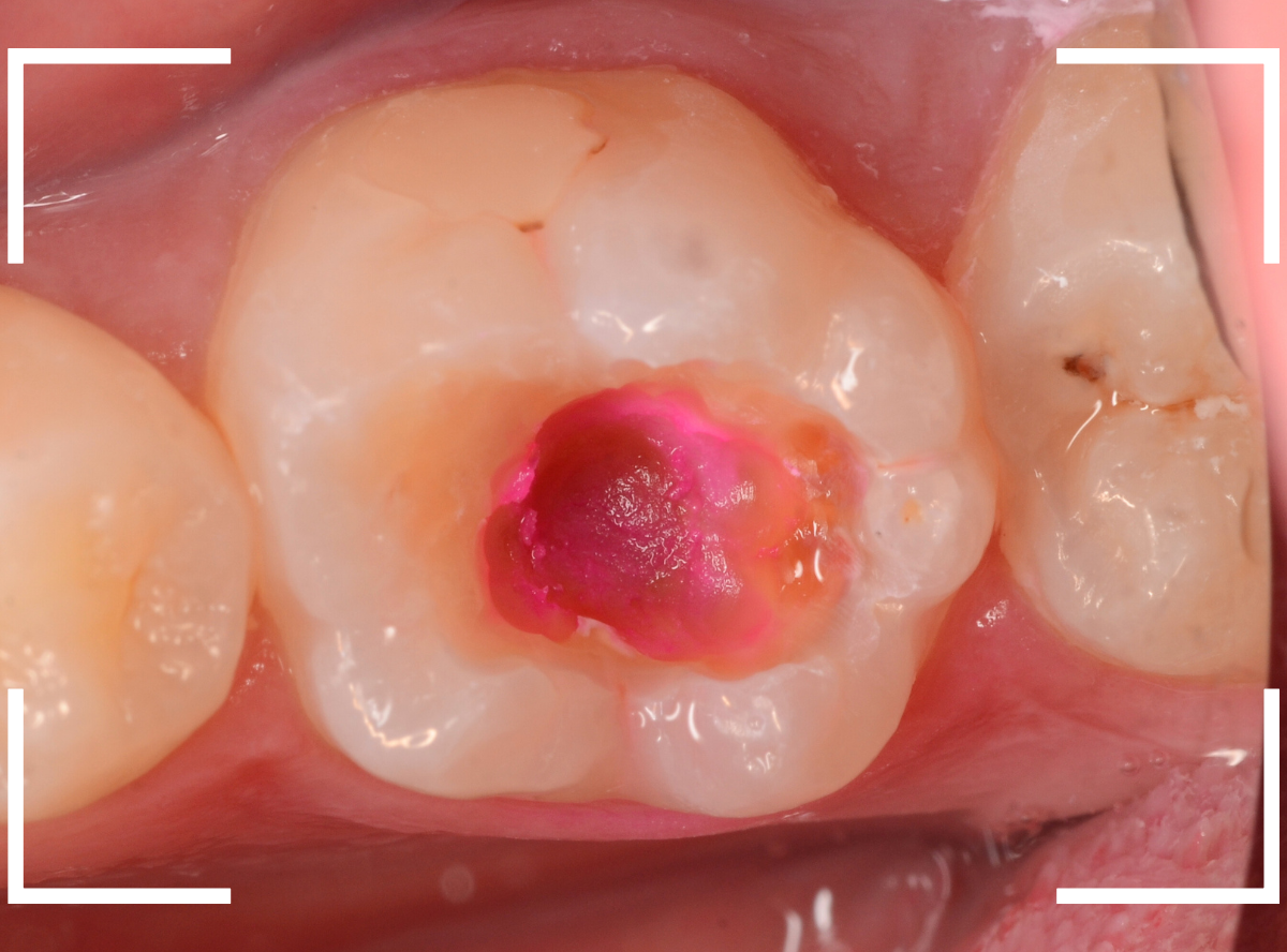 小窩裂溝う蝕5-4