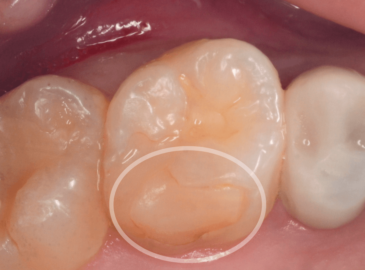 レントゲンでわかりづらい虫歯1-1