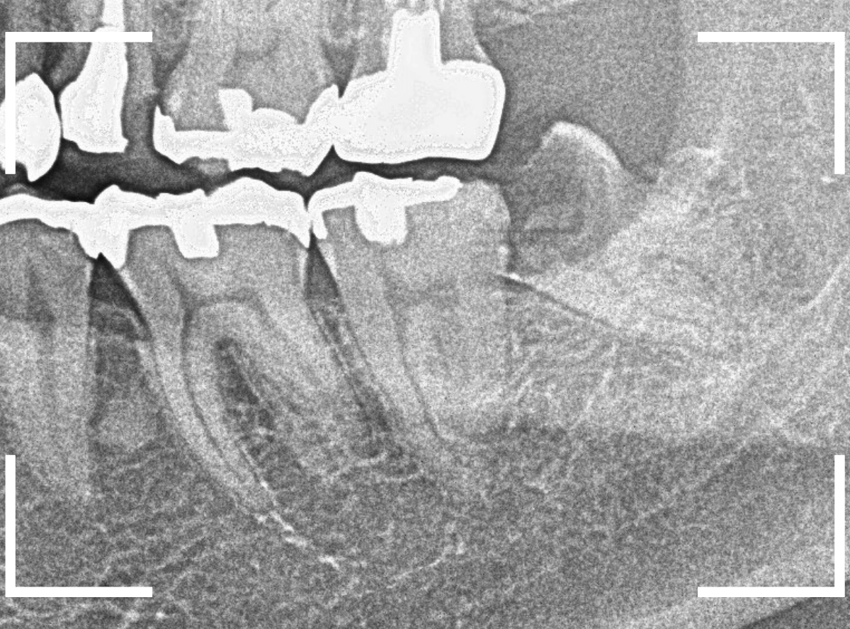 おやしらずの抜歯8-2