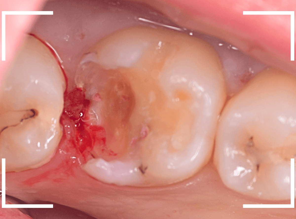 歯と歯の間の虫歯23-5