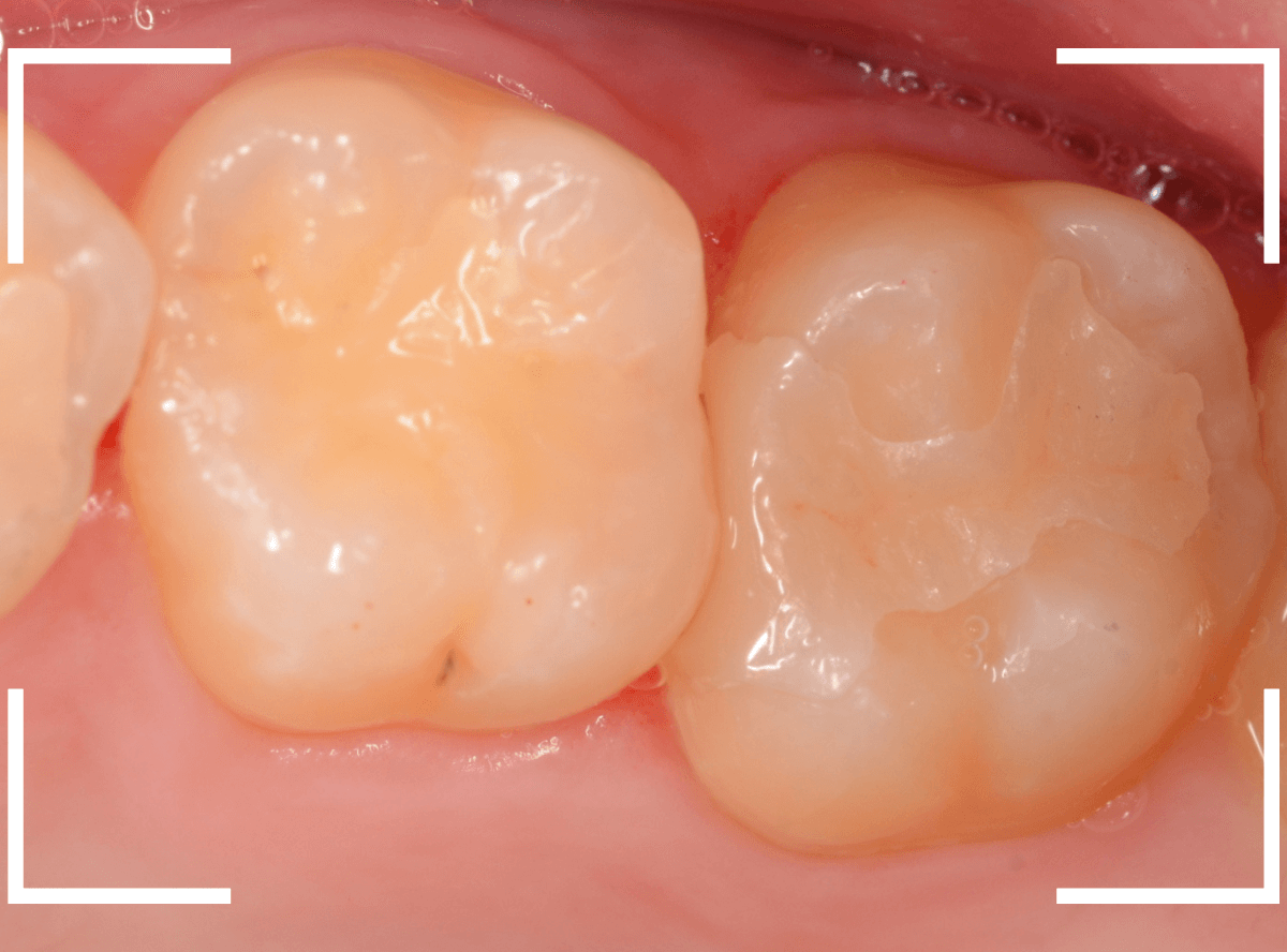セラミック治療(インレー)29-4
