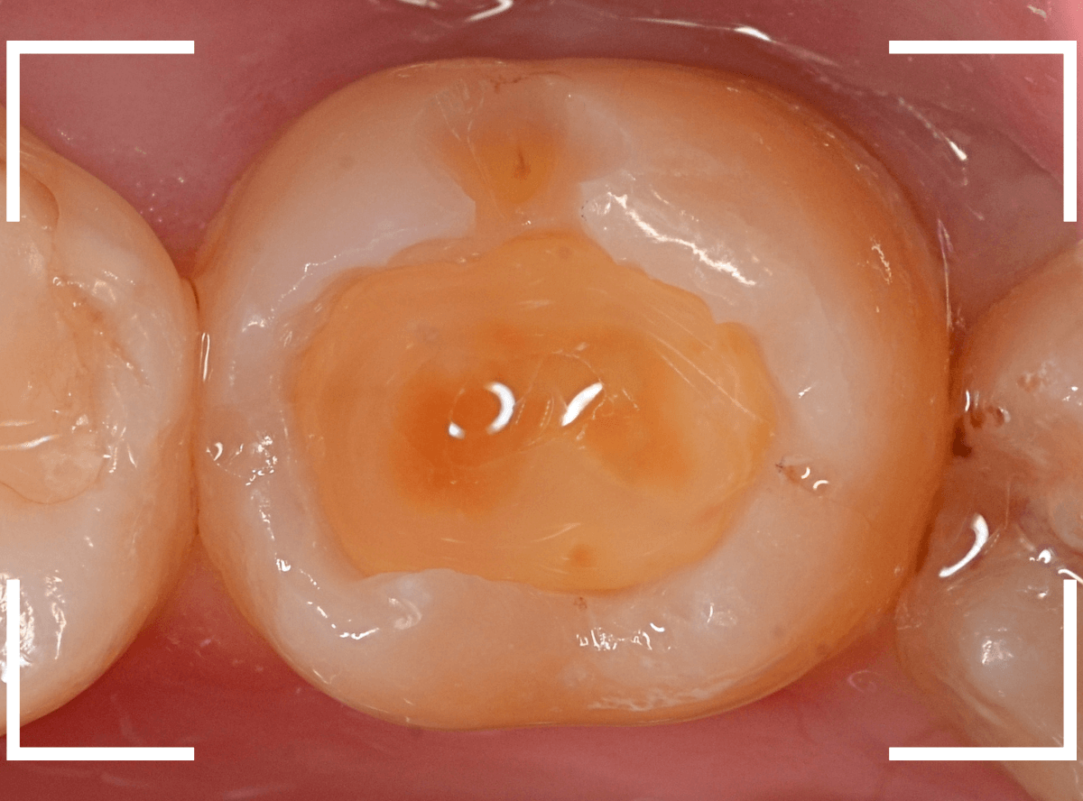 レントゲンでわかりづらい虫歯17-6
