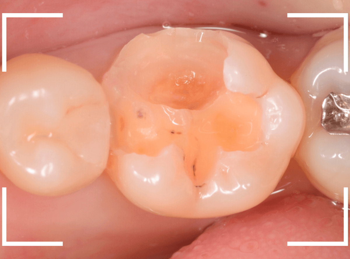 つめものの下の深い深い虫歯20-1